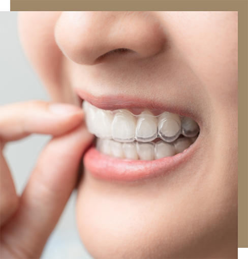 Person removing a clear aligner from their teeth