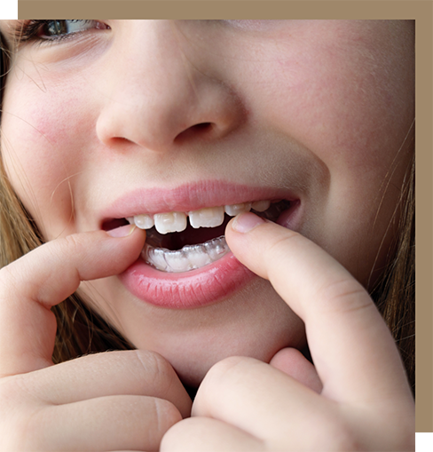 Placing a clear aligner over crooked lower teeth