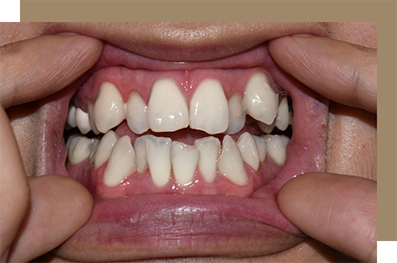 Mouth with crowded teeth