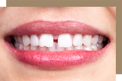 Smile with a gap between the two front teeth