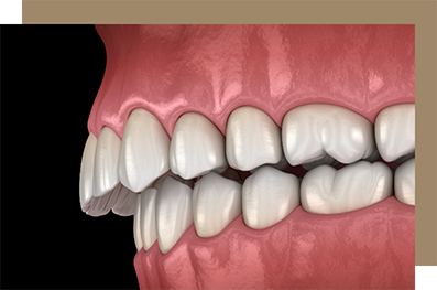 Illustrated overbite