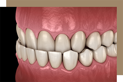 Illustrated underbite