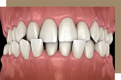 Illustrated crossbite