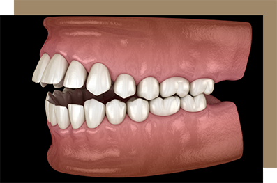 Illustrated open bite