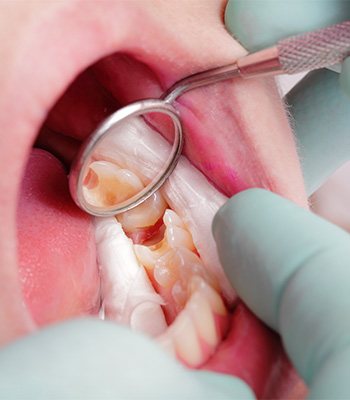 Closeup of dental mirror reflecting lower teeth with cavities