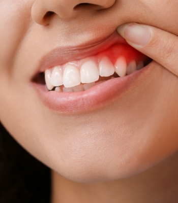 Nose-to-neck closeup of someone lifting up their lip to reveal dark red gums