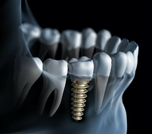 Animated smile with dental implant supported dental crown