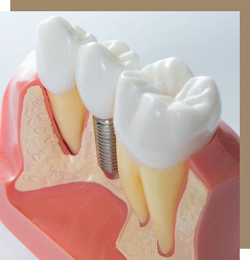 Model of a dental implant between two natural teeth