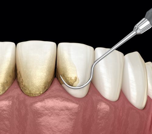 Animated smile during scaling and root planing treatment