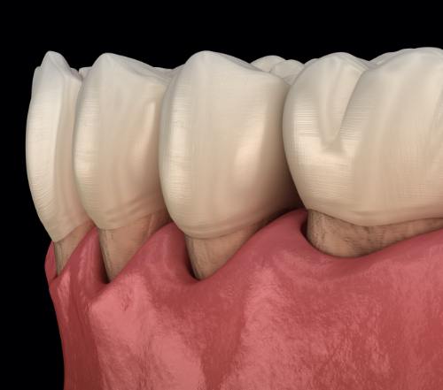 Animated smile with receding gums before periodontal therapy