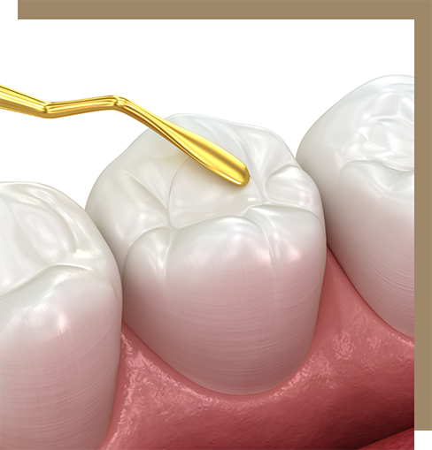 Illustration of sealants applied to a tooth