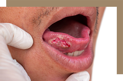 Man with a white and red patch under his tongue
