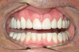 Healthy beautiful smile after full mouth reconstruction