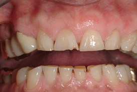 Severe dental wear and damage