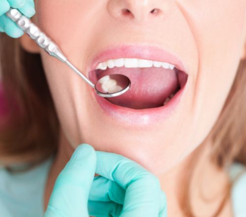 Dentist examining patient's tooth colored filling during restorative dentistry visit