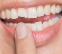 Person pointing to chipped tooth before dental crown