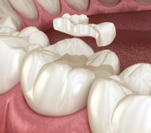 Animated smile during tooth colored filling placement