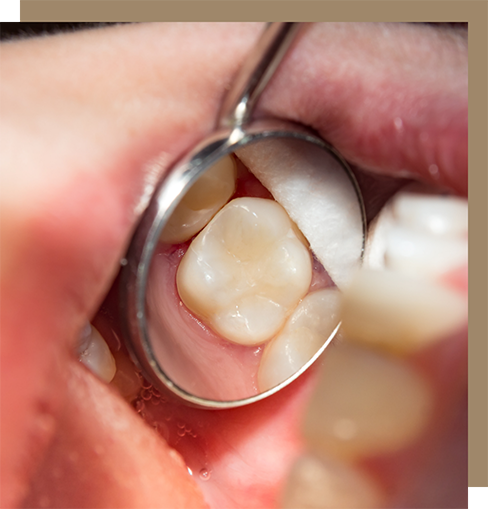 Dental mirror in the mouth reflecting a flawless tooth