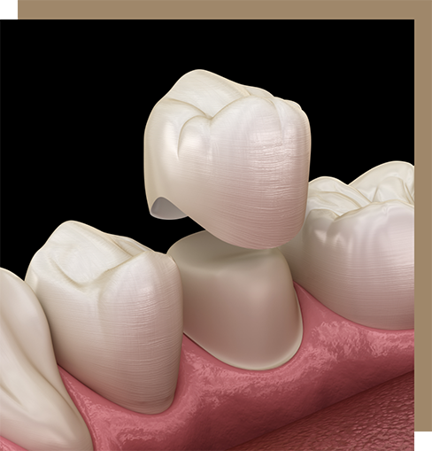Illustration of a dental crown covering a tooth