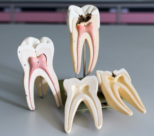 Model of the inside of healthy tooth compared to decayed tooth in need of root canal therapy