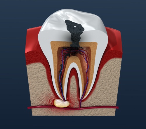 Animated tooth with decay before root canal therapy