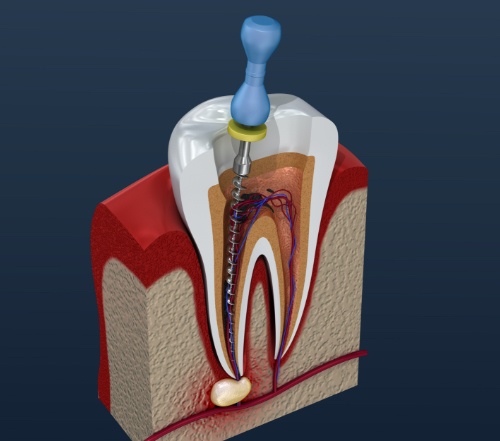 Animation tooth during root canal therapy