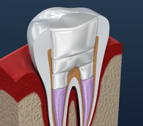 Animated tooth after root canal therapy