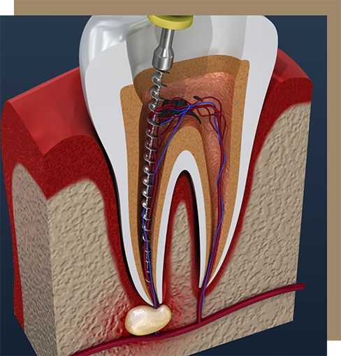 Illustration of a dental instrument treating the root of a tooth