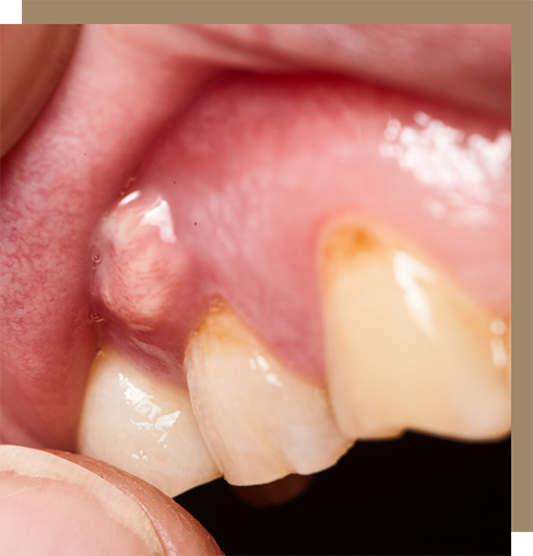 Close up of a bump on the gums