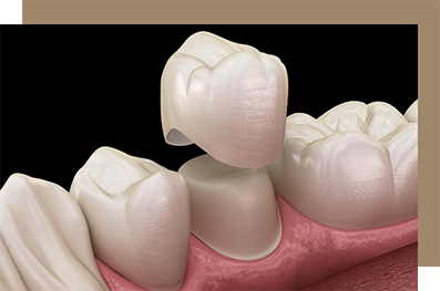 Model of a dental crown covering a tooth