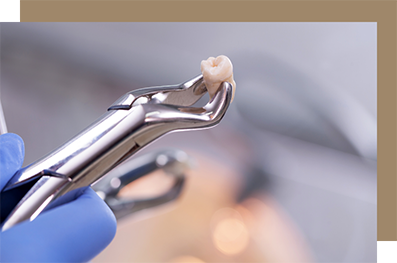 Forceps holding an extracted tooth