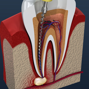 factors that can influence the cost of a root canal treatment include the location of the tooth and the severity of the infection