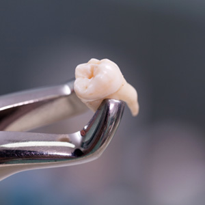 Extracting an infected tooth may seem more affordable than a root canal but may end up costing more overall