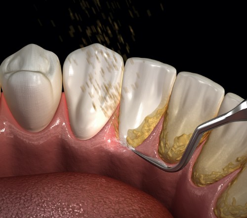 Animated smile during scaling and root planing process