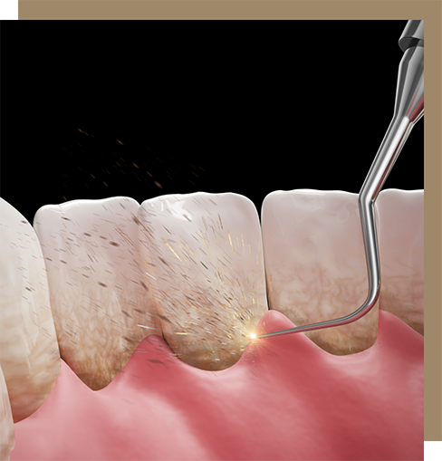 Illustration of the scaling and root planing process