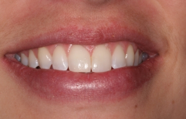 Smile after correcting yellow discoloration with dental bonding