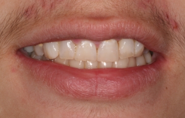 Teeth after being reshaped and whitened