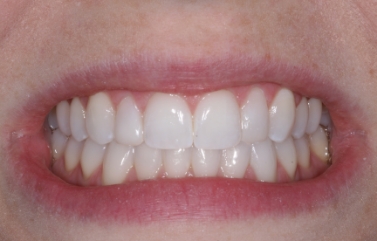 Smile with the canines aligned with the rest of the teeth
