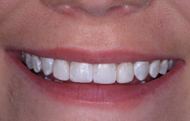 Smile after removing yellow stains on several teeth