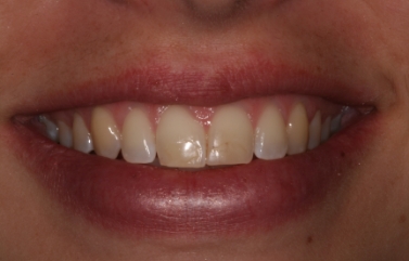 Smile with yellow discoloration on the teeth