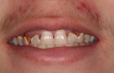 Teeth that are misshapen and discolored