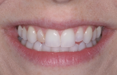 Smile with the canines behind the other teeth