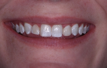 Smile with yellow stains on several teeth
