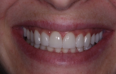 Evenly spaced and colored teeth