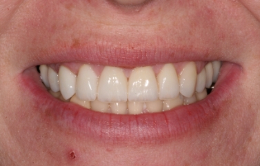 Smile after correcting discoloration on and between the teeth