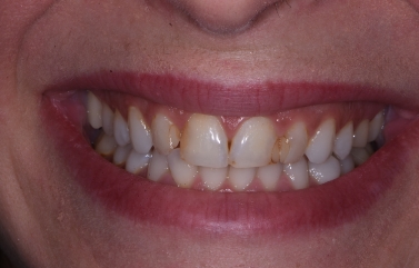 Slightly gapped and stained teeth
