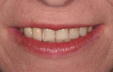 Smile with slight discoloration on and between the teeth
