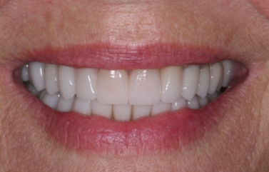 Smile with new, natural-looking dental restorations