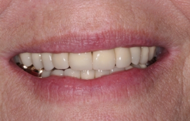 Smile with old gold dental crowns on the molars