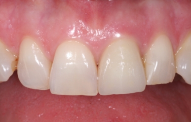 Missing upper front tooth replaced with a dental implant and crown